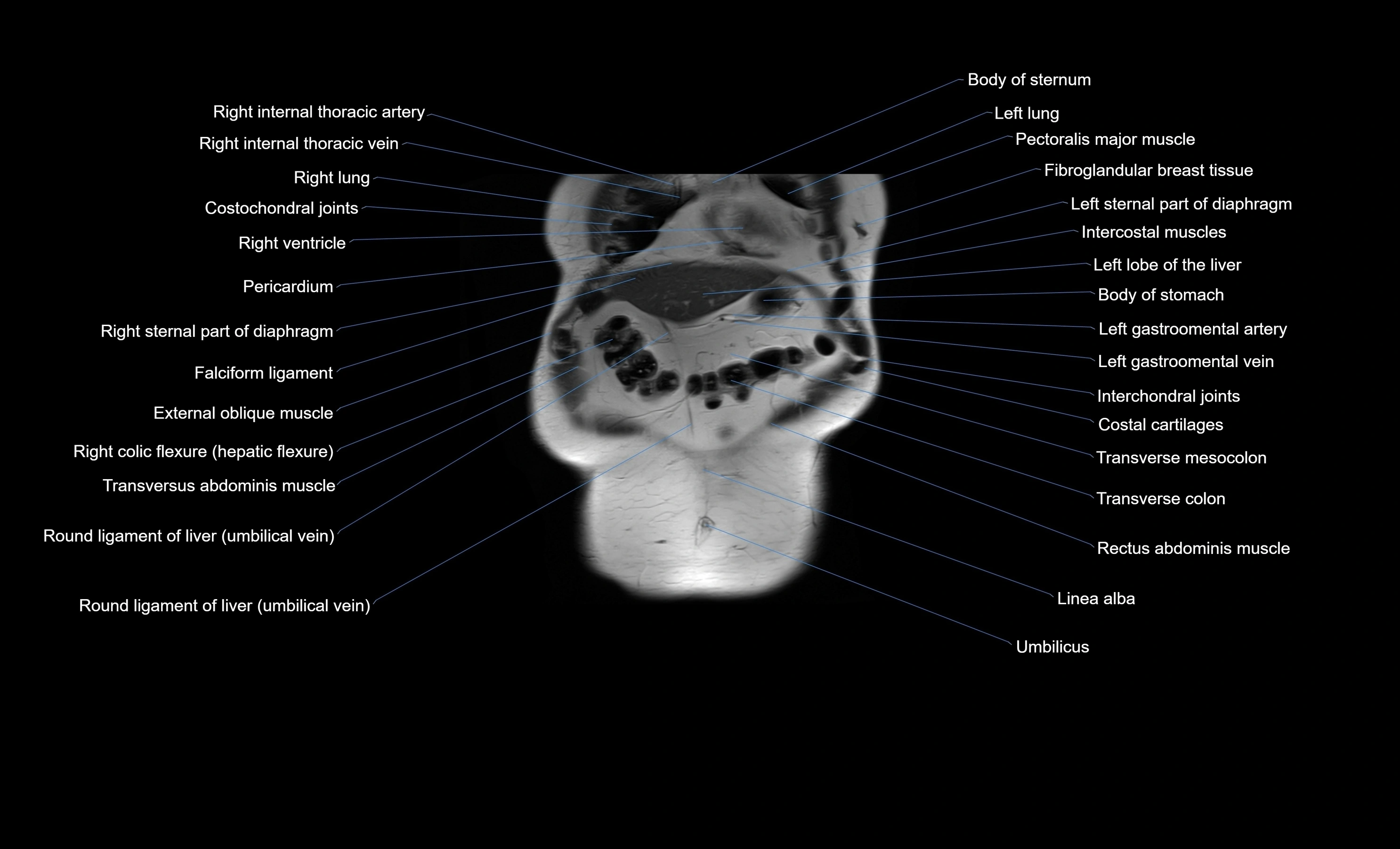 MRI Abdomen coronal labelled cross sectional anatomy radiology  image-img-00001-00010.webp